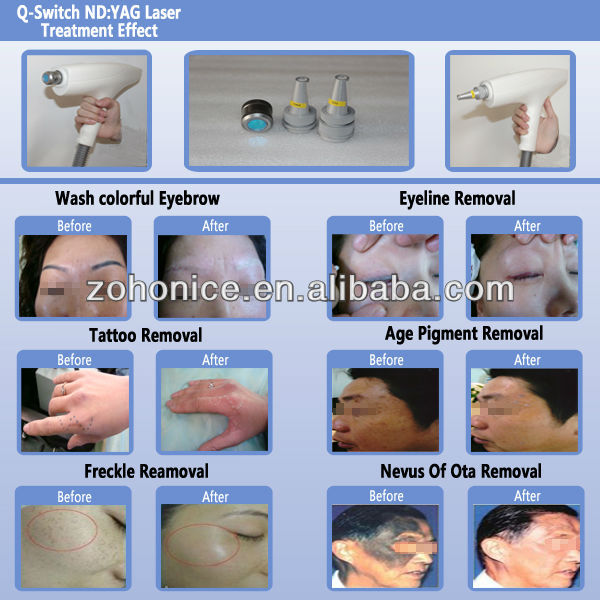 Portable ND YAG Laser eyebrow embroidery tatoo Removal In Hot Sale