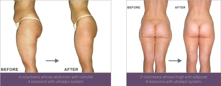 Hot!! Portable fat cavitation slimming machine S50(CE&ISO)portable home use liposuction cavitation machine