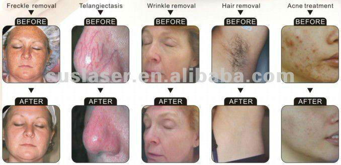 2013 best Hair removal machine S3000 CE/ISO aft skin rejuvenation machine