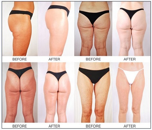 Hot!suslaser cavitation RF SMOOSKIN I S60 CE/ISO ultrasonic cavitation lipo machine