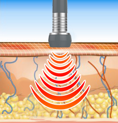Hot!suslaser cavitation RF SMOOSKIN I S60 CE/ISO ultrasonic cavitation lipo machine