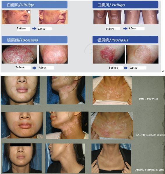 KN-4006B/BL Narrowband uvb 311nm Phototherapy equipment