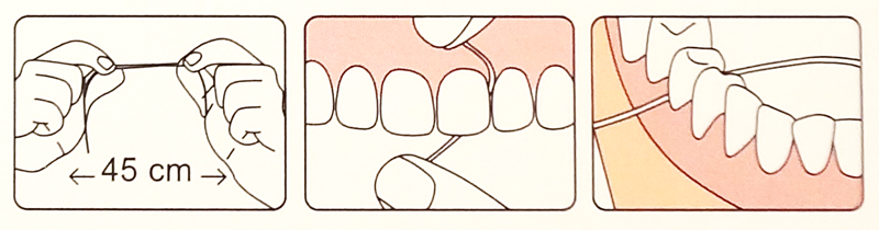 Как пользоваться зуб. Как правильно пользоваться зубной нитью схема. Х флосс схемы. Как часто можно пользоваться зубной нитью.