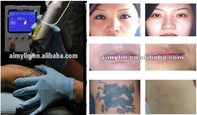 Tatoo Removal Laser - Buy Tatoo Removal Laser,Tattoo ...