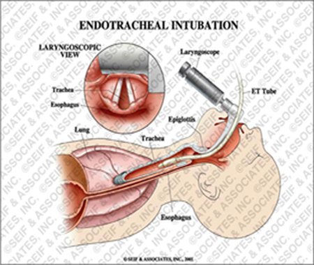 adult size of endotracheal intubation adult size of endotracheal intubation