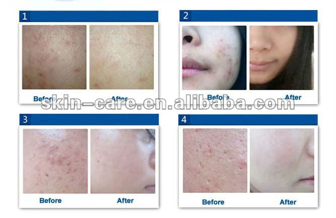  Scar Removal Cream - Buy Acne Scar Removal Cream,Acne Cream,Scar